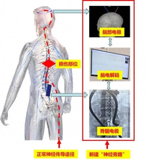 完全截瘫患者在上海奇迹康复，重新行走人生路！揭秘背后的故事与未来展望。